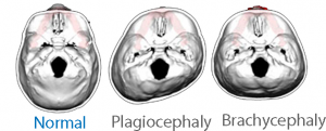brain flat head